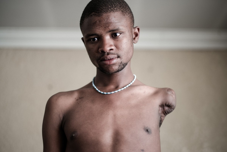 Sibusiso Linda stracił obydwie ręce i nogę wskutek porażenia prądem w 2007 roku; fot. Marco Casino
